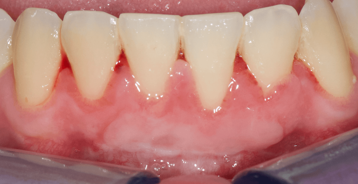 Gingivite-parodontite-maladie-gencive