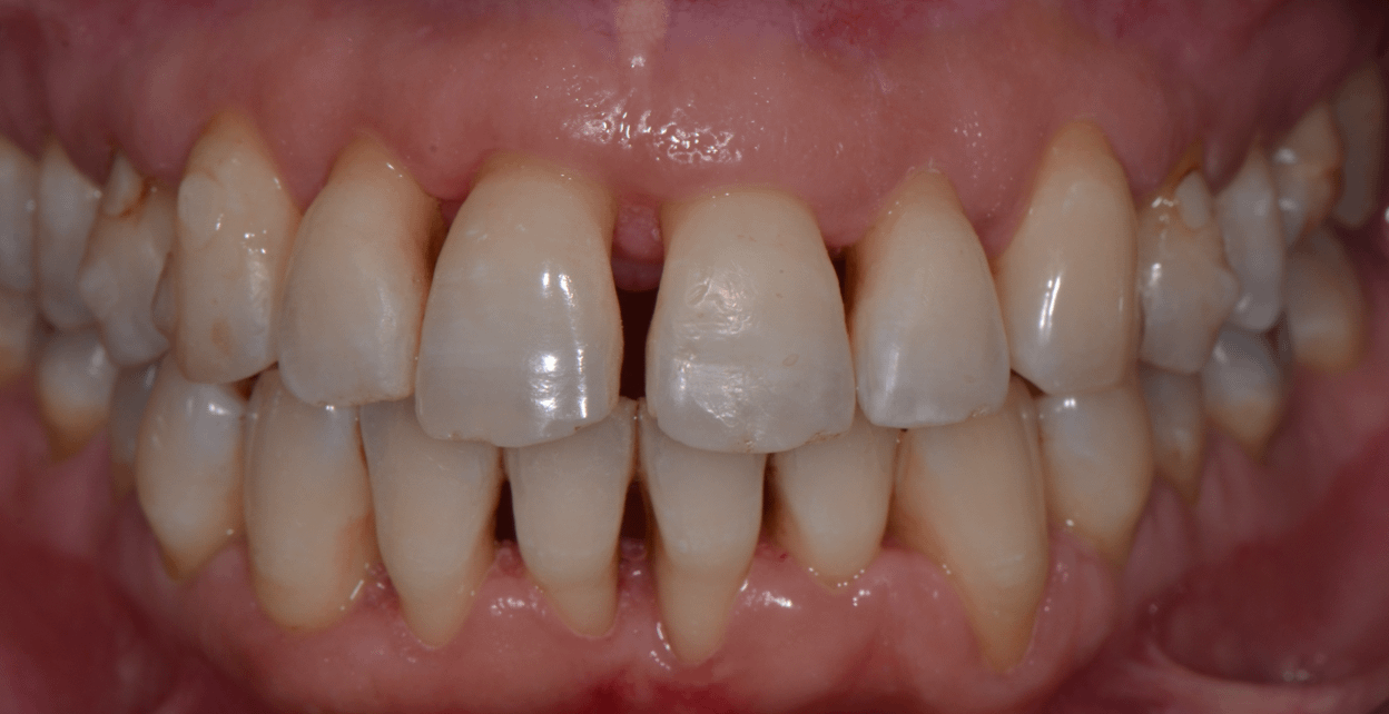 parodontie-gencive-dents-parodontiste