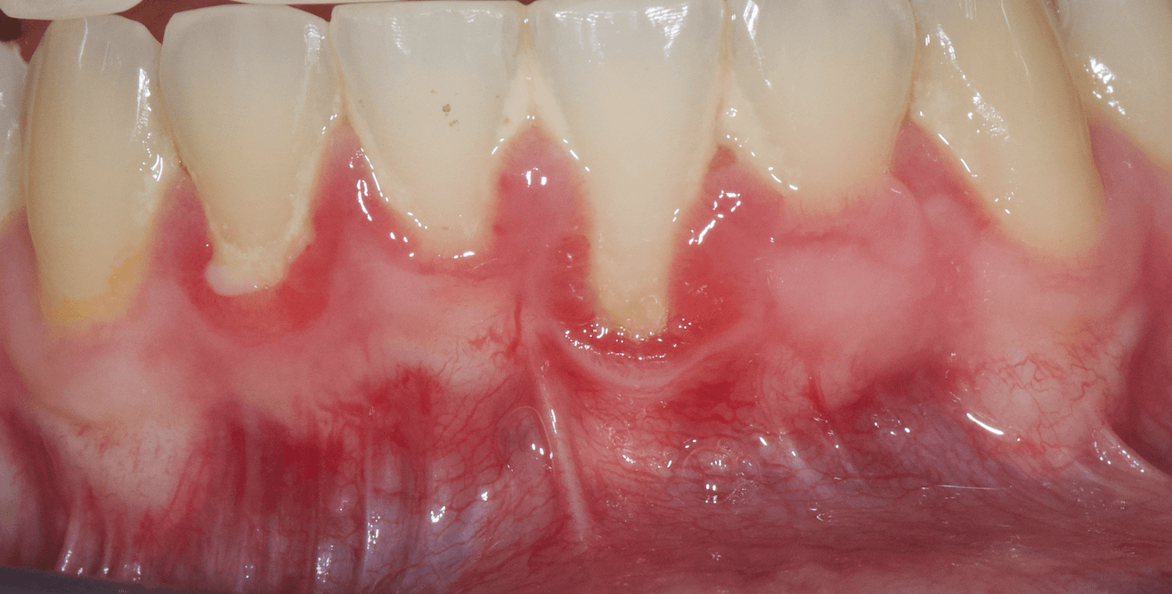 greffe-gengivale-gingivite-parodontie