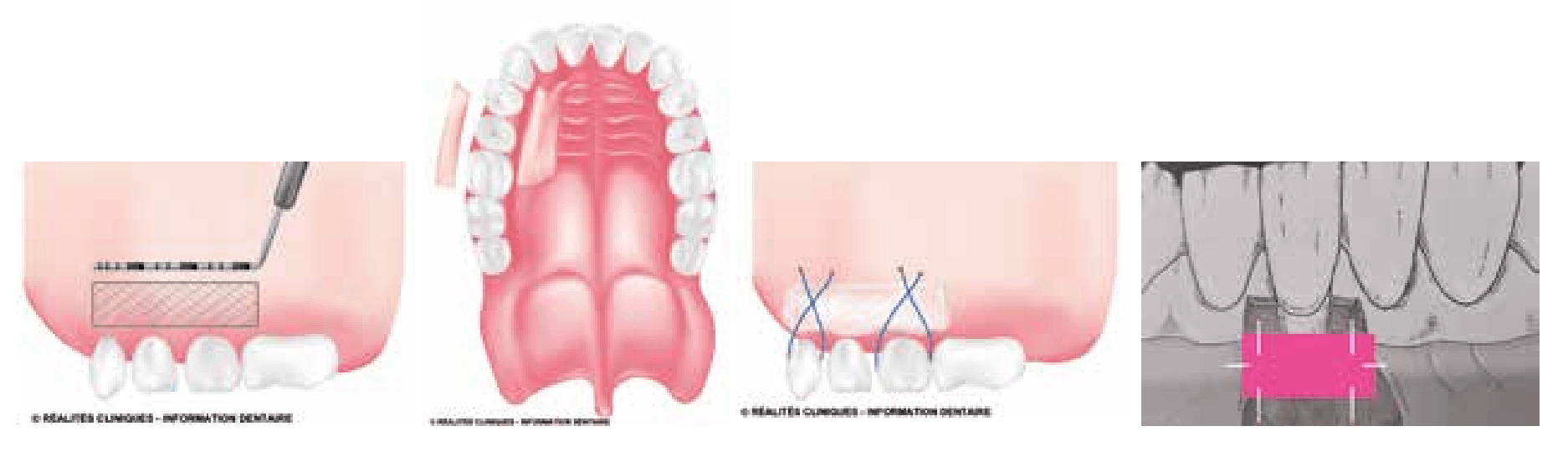 greffes-gencives-paro-expert-parodontite