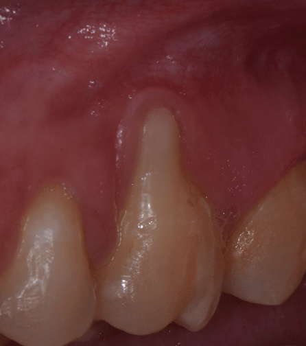 Gingivite-parodontite-boulogne-billancourt