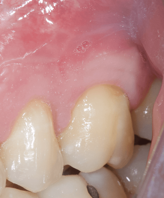 gingivite-parodontite-paroexpert-boulogne