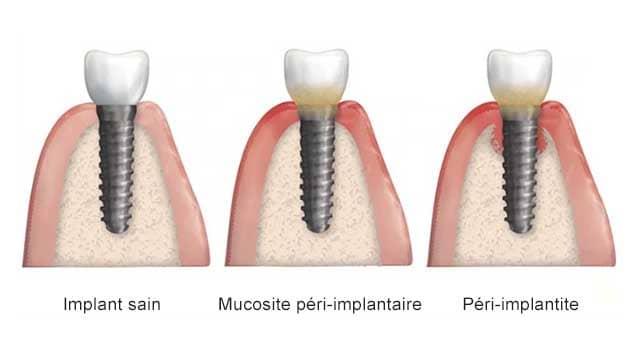 Péri-implantite-implant-paro-expert-boulogne