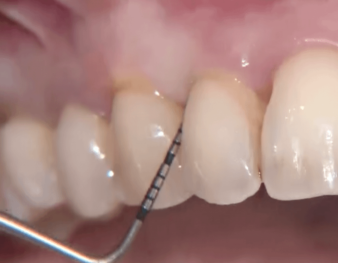 résultat-lallam-parodontie