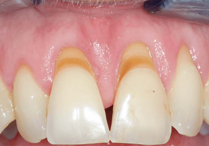 parodontal-boulogne-billancourt-gingivite
