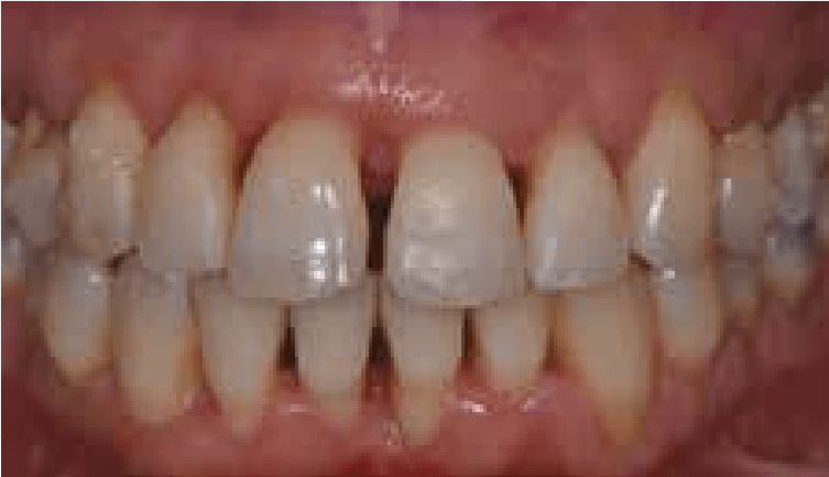 assainissement-parodontal-surfacage-parodontite-boulogne