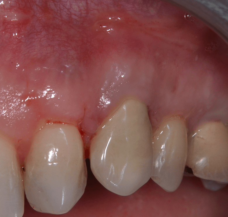 parodontie-boulogne-expert-rédultat