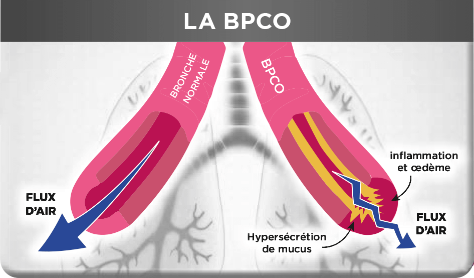 BCPO-maladies-parodontales-paro-expert
