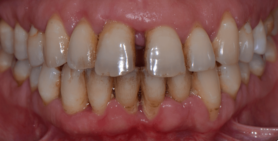 Parodontite-dent-gencive-traitement