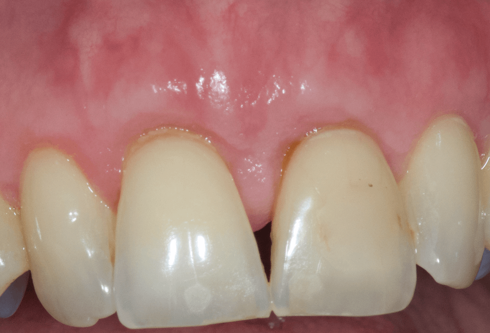 parodontal-gencivite-parodontie-traitement-résultat